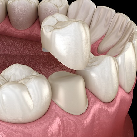 Digital image of a metal-free dental crown