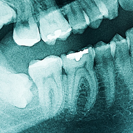 Digital bitewing x-rays